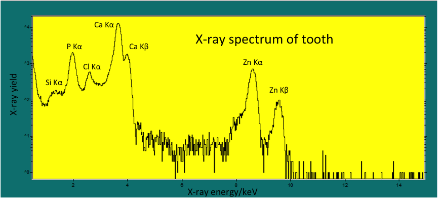 PIXE spectrum of a tooth at Louisiana Accelerator Center UL Lafayette