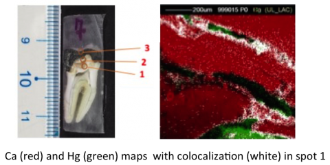 Image showing regions of Hg and Ca and co-localized Ca and Hg
